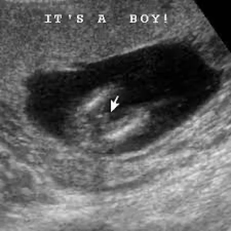 3d ultrasound