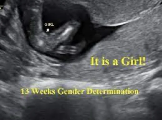 3d ultrasound