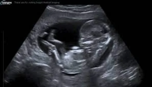 2D 3D 4D Ultrasound