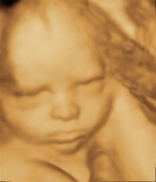 2D 3D 4D Ultrasound